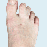 Correction of Webbed Toes in Germany