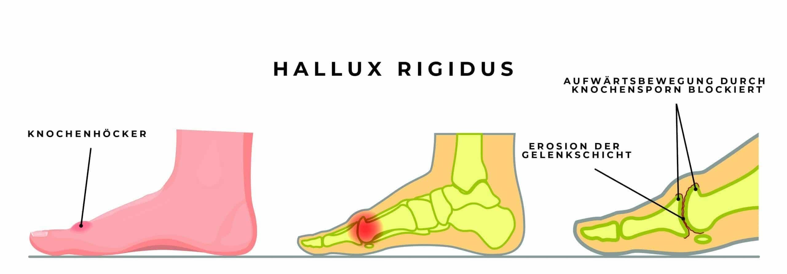 Hallux Rigidus OP - Wann ist diese gerechtfertigt? - Adem ...